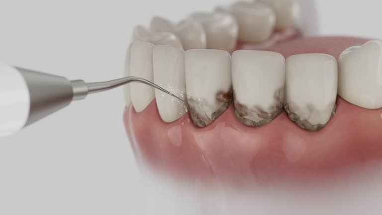 Trusted Wisdom Tooth Removal service in Winchester, CA - Dentist Open Now